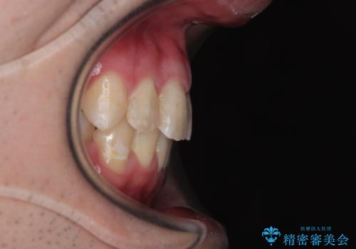 【モニター】出っ歯と奥歯の咬み合わせを改善 補助装置を用いたワイヤー抜歯矯正の治療後