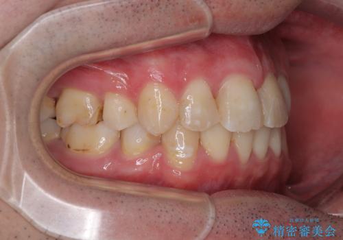 【モニター】出っ歯と奥歯の咬み合わせを改善 補助装置を用いたワイヤー抜歯矯正の治療後