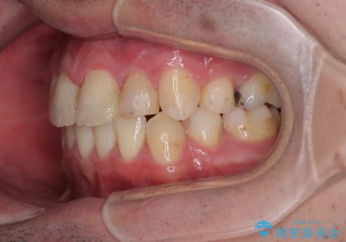 【モニター】出っ歯と奥歯の咬み合わせを改善 補助装置を用いたワイヤー抜歯矯正の治療後