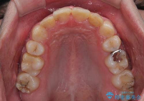 【モニター】出っ歯と奥歯の咬み合わせを改善 補助装置を用いたワイヤー抜歯矯正の治療後