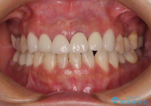 新幹線通院 地元で断られた奥歯のむし歯治療の症例 治療後