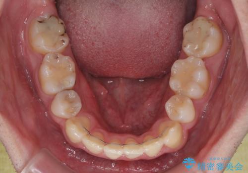 【モニター】出っ歯と奥歯の咬み合わせを改善 補助装置を用いたワイヤー抜歯矯正の治療後