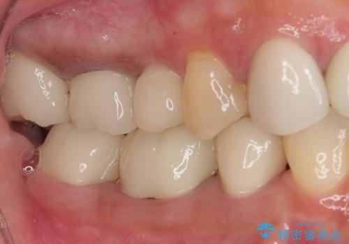 新幹線通院 地元で断られた奥歯のむし歯治療の治療後