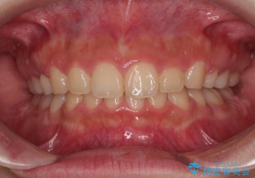 骨格的な出っ歯を抜歯矯正で改善 横顔の印象が劇的に変化の症例 治療後