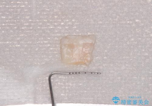 矯正治療で退縮した歯肉　歯肉移植による根面被覆術の治療前