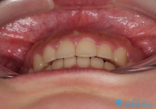 骨格的な出っ歯を抜歯矯正で改善 横顔の印象が劇的に変化の治療後