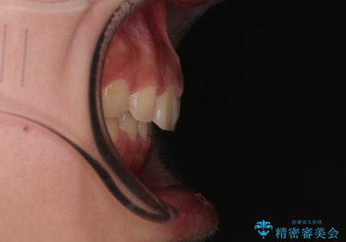 骨格的な出っ歯を抜歯矯正で改善 横顔の印象が劇的に変化の治療後