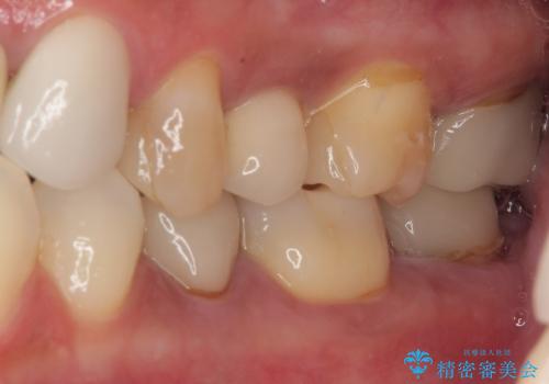 新幹線通院 地元で断られた奥歯のむし歯治療の治療後