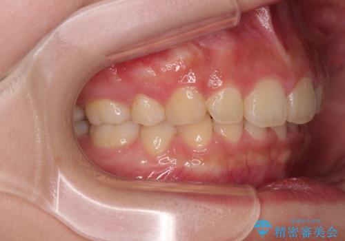 骨格的な出っ歯を抜歯矯正で改善 横顔の印象が劇的に変化の治療後
