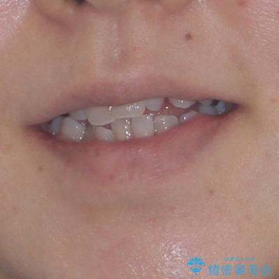 骨格的なズレを歯列矯正でカバー ワイヤー装置での非抜歯矯正の治療前(顔貌)