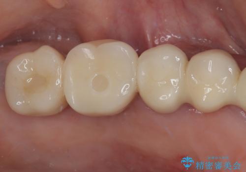 抜けてしまった奥歯 短期間インプラント治療の症例 治療後