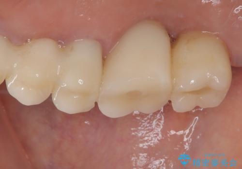 抜けてしまった奥歯 短期間インプラント治療の治療後
