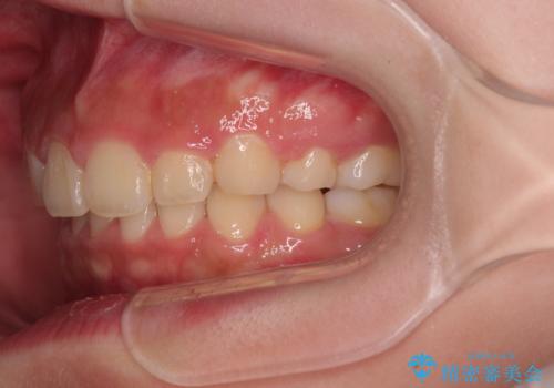 骨格的な出っ歯を抜歯矯正で改善 横顔の印象が劇的に変化の治療後