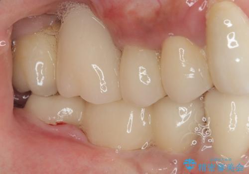 抜けてしまった奥歯 短期間インプラント治療の治療後
