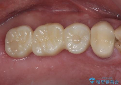 割れてしまった奥歯 抜歯即時埋入インプラントによる短期間治療の症例 治療後