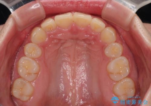 骨格的な出っ歯を抜歯矯正で改善 横顔の印象が劇的に変化の治療後