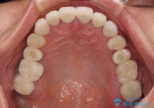 新幹線通院 地元で断られた奥歯のむし歯治療の治療後