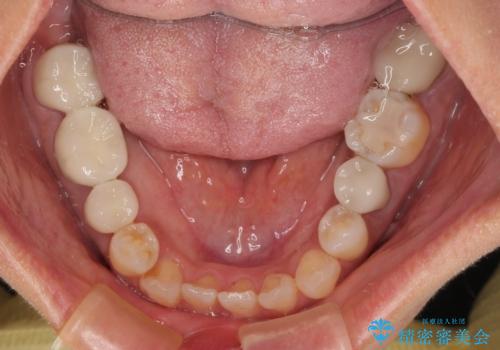 新幹線通院 地元で断られた奥歯のむし歯治療の治療後