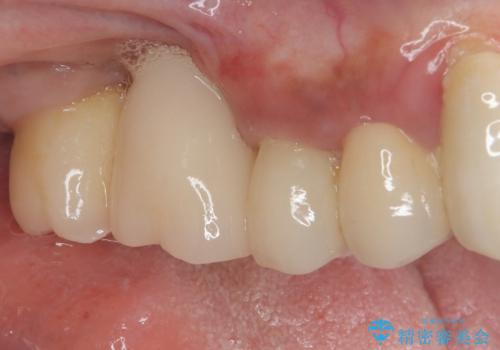 抜けてしまった奥歯 短期間インプラント治療の治療後