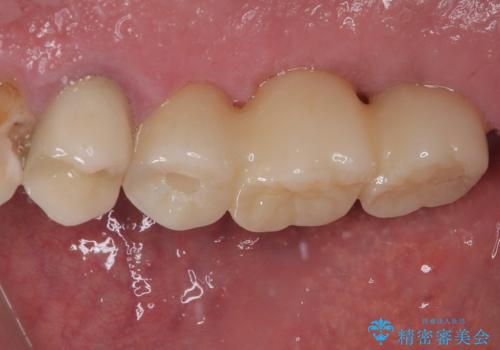割れてしまった奥歯 抜歯即時埋入インプラントによる短期間治療の治療後