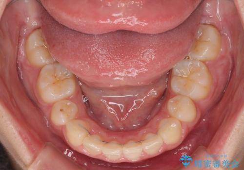 骨格的な出っ歯を抜歯矯正で改善 横顔の印象が劇的に変化の治療後