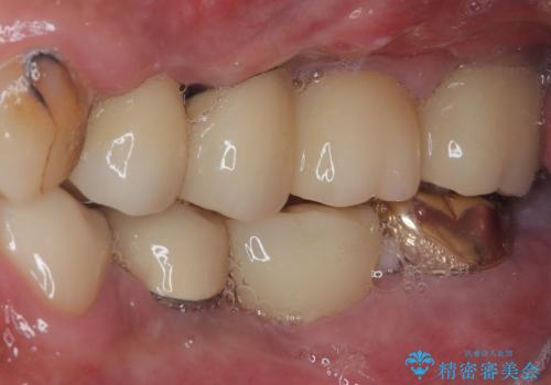 割れてしまった奥歯 抜歯即時埋入インプラントによる短期間治療の治療後