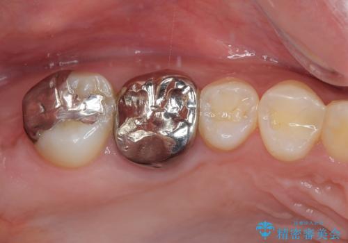 挺出歯を圧下してスペースを確保!目立たない部分矯正で下顎大臼歯にインプラント治療を実現の治療前