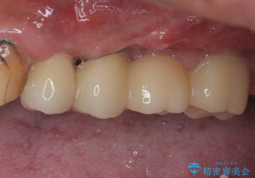 割れてしまった奥歯 抜歯即時埋入インプラントによる短期間治療の治療後