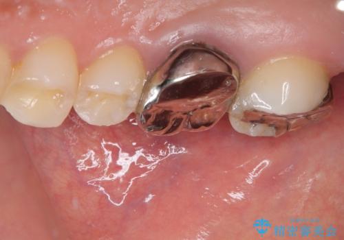 挺出歯を圧下してスペースを確保!目立たない部分矯正で下顎大臼歯にインプラント治療を実現の治療前