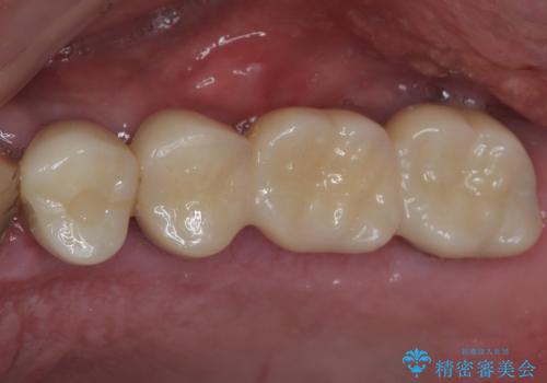 割れてしまった奥歯 抜歯即時埋入インプラントによる短期間治療の治療後