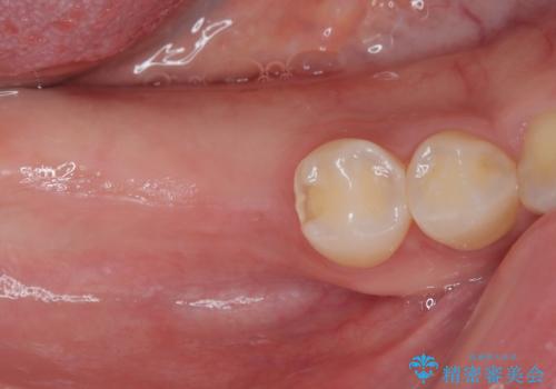 挺出歯を圧下してスペースを確保!目立たない部分矯正で下顎大臼歯にインプラント治療を実現の治療前
