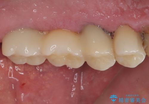 割れてしまった奥歯 抜歯即時埋入インプラントによる短期間治療の治療後