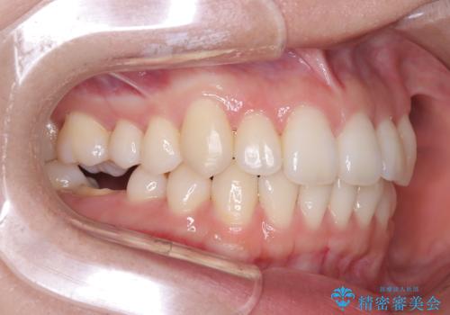 非抜歯矯正で八重歯を改善|短期間8か月で美しい歯並びに|インビザラインライト上顎のみで矯正の治療後