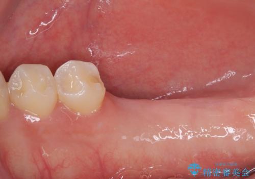 挺出歯を圧下してスペースを確保!目立たない部分矯正で下顎大臼歯にインプラント治療を実現の治療前