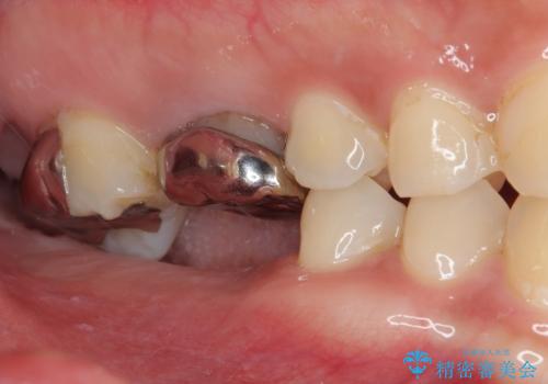 挺出歯を圧下してスペースを確保!目立たない部分矯正で下顎大臼歯にインプラント治療を実現の症例 治療前