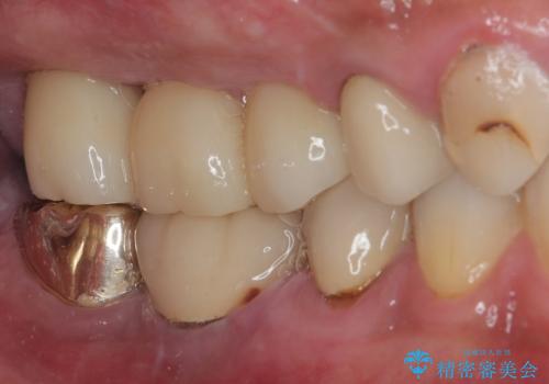 割れてしまった奥歯 抜歯即時埋入インプラントによる短期間治療の治療後