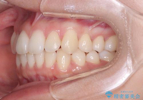 非抜歯矯正で八重歯を改善|短期間8か月で美しい歯並びに|インビザラインライト上顎のみで矯正の治療後