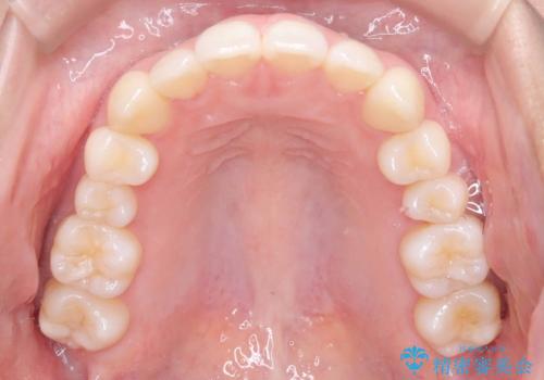 非抜歯矯正で八重歯を改善|短期間8か月で美しい歯並びに|インビザラインライト上顎のみで矯正の治療後