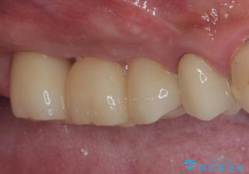 割れてしまった奥歯 抜歯即時埋入インプラントによる短期間治療の治療後
