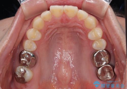 挺出歯を圧下してスペースを確保!目立たない部分矯正で下顎大臼歯にインプラント治療を実現の治療前