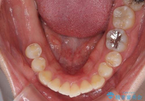 挺出歯を圧下してスペースを確保!目立たない部分矯正で下顎大臼歯にインプラント治療を実現の治療前