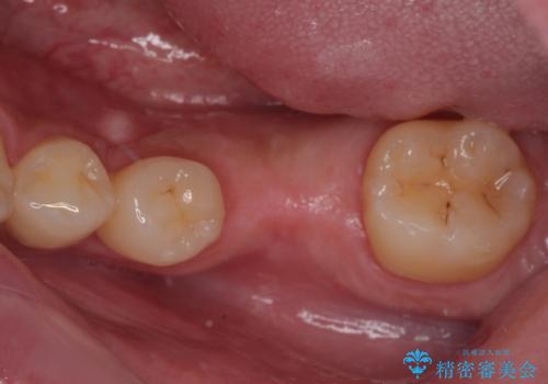 放置した欠損部 奥歯の即時荷重インプラント治療の治療前