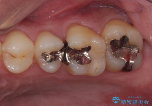 放置した欠損部 奥歯の即時荷重インプラント治療の治療前