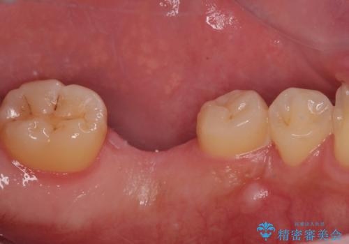 放置した欠損部 奥歯の即時荷重インプラント治療の治療前