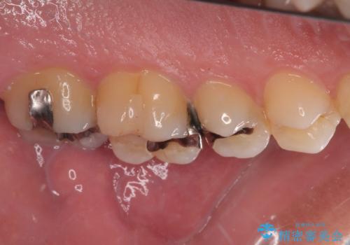 放置した欠損部 奥歯の即時荷重インプラント治療の治療前