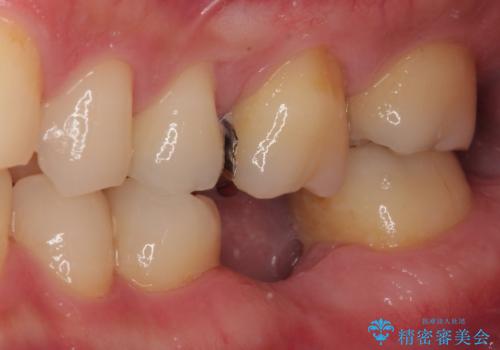 放置した欠損部 奥歯の即時荷重インプラント治療の症例 治療前