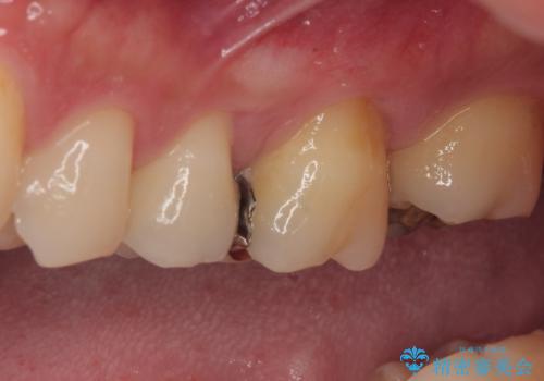 放置した欠損部 奥歯の即時荷重インプラント治療の治療前