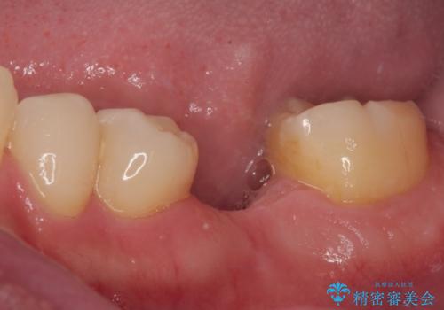 放置した欠損部 奥歯の即時荷重インプラント治療の治療前
