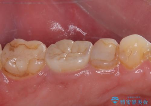 歯肉が腫れてズキズキする　奥歯の根管治療の治療前