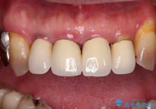 強い咬合力で奥歯がボロボロに インプラント治療による咬合回復と全顎セラミック治療の治療前